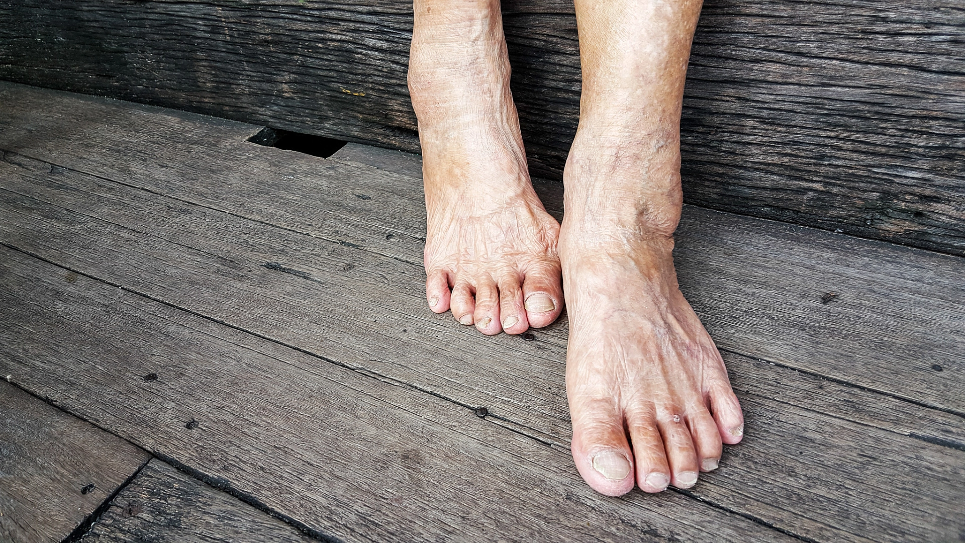 Toenail Fungus Study