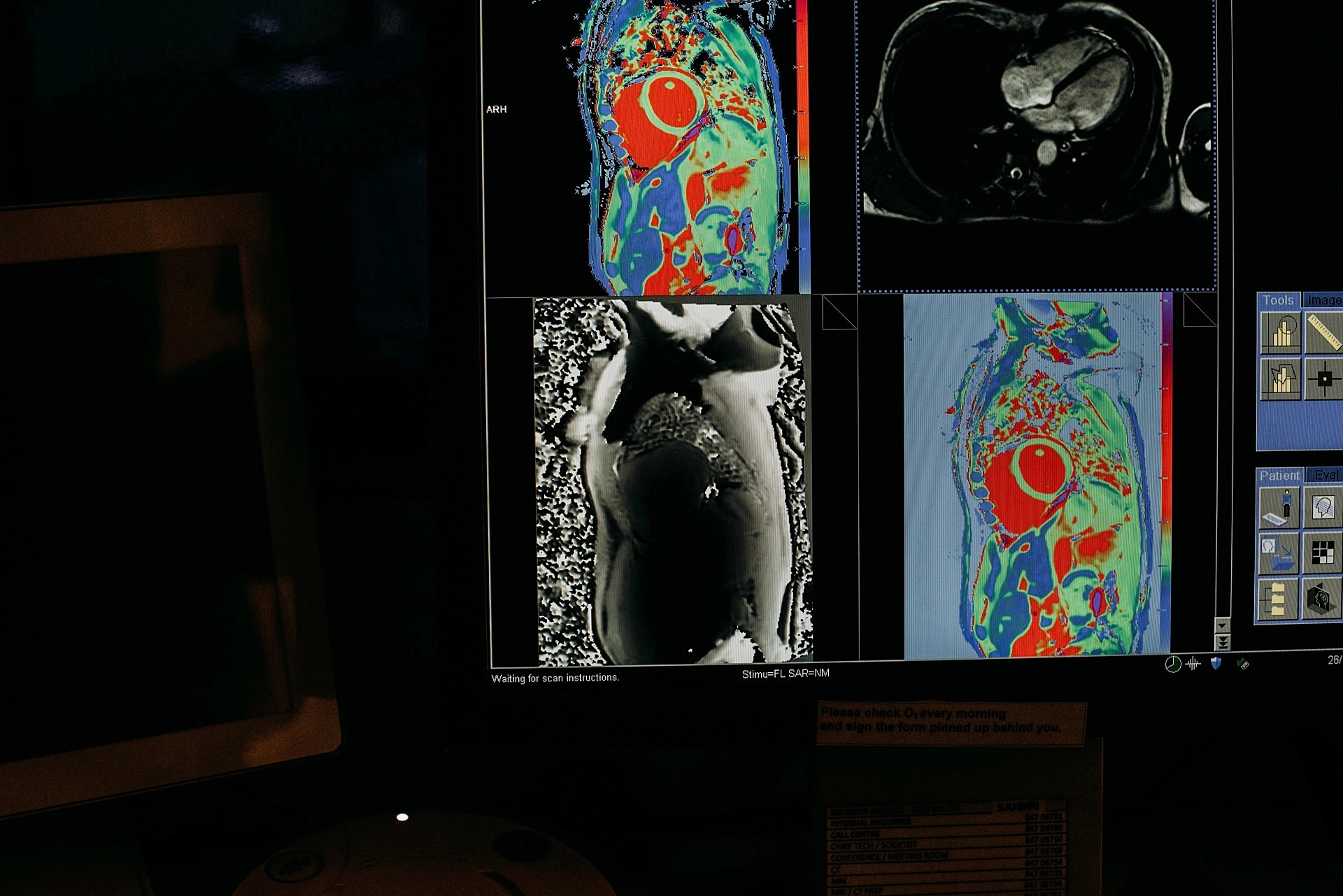 Nanoparticles engineered to suck the plaque out of arteries