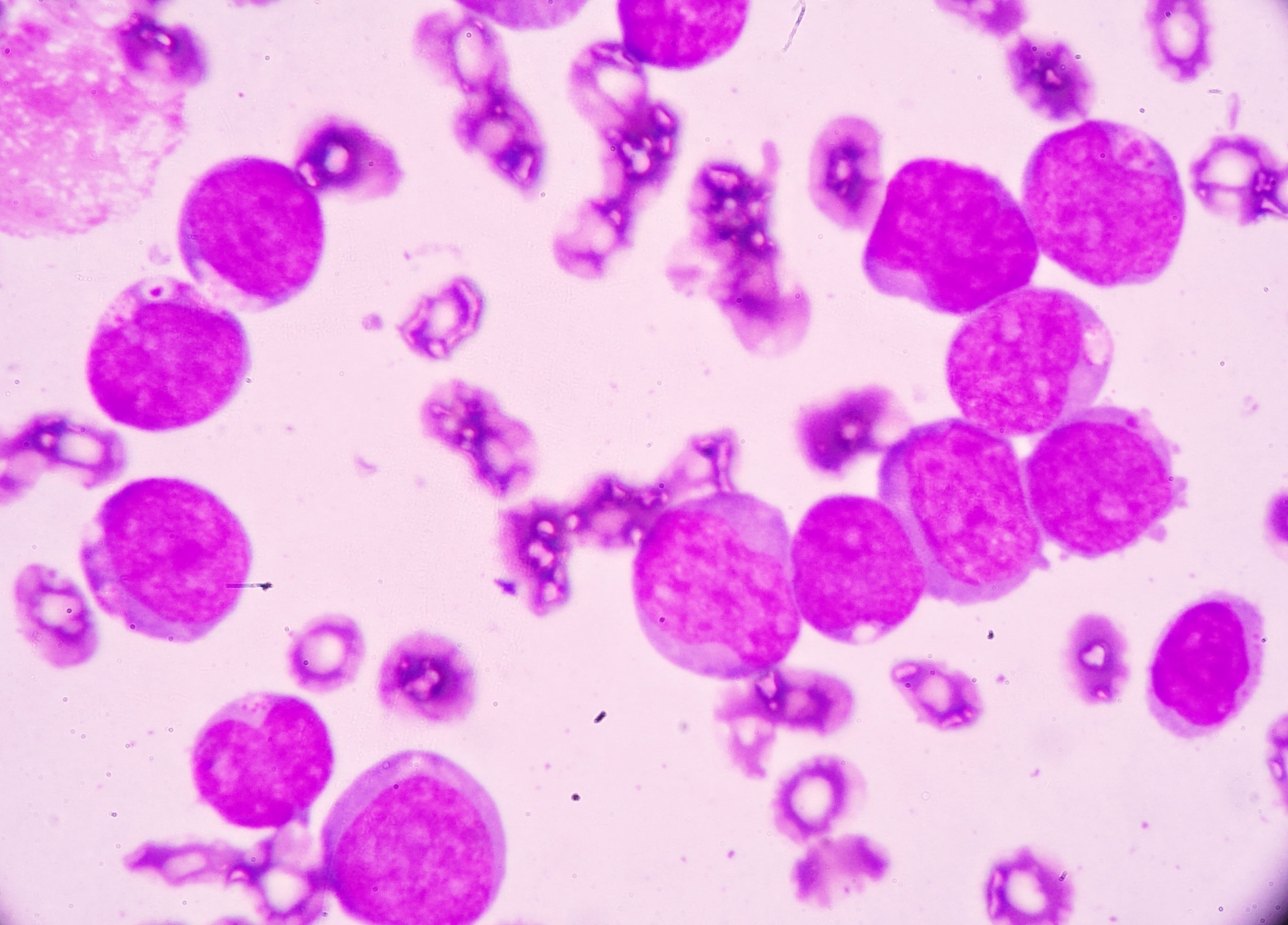 New therapy could help chronic myeloid leukaemia patients live drug-free