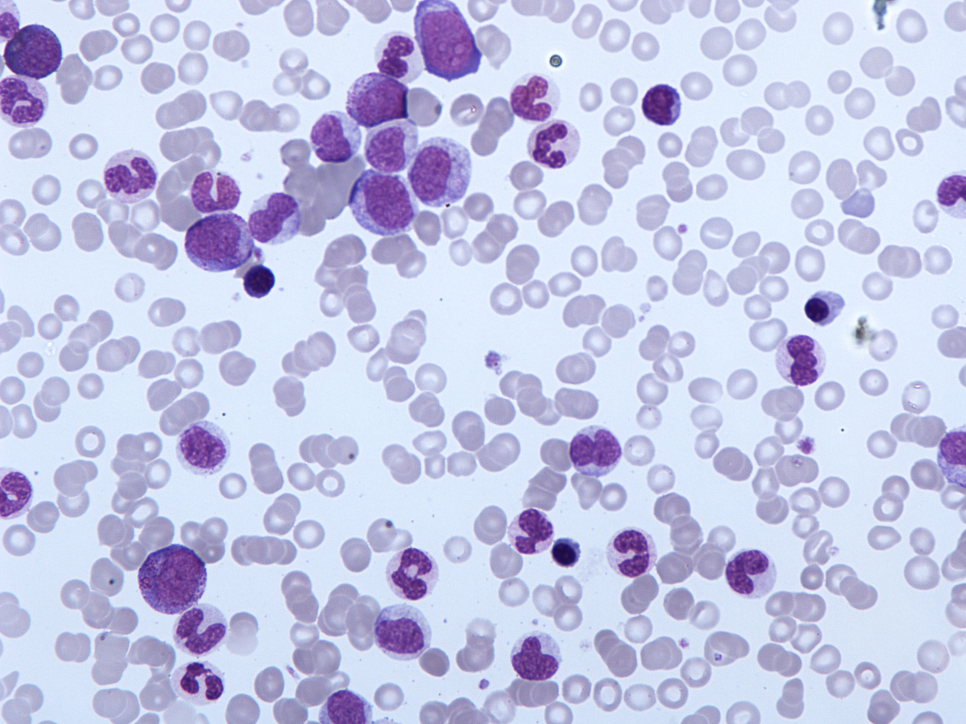 Rapid expansion for SAHMRI-led leukaemia study