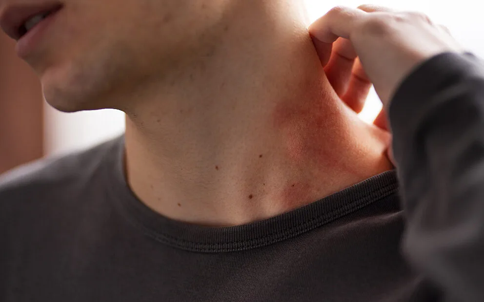 Could a plant protect skin from radiotherapy?