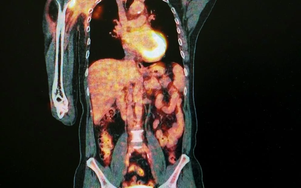 A milestone for cancer detection in South Australia