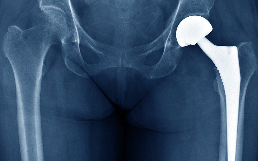 Partnership announced for one of the world's best joint replacement registries