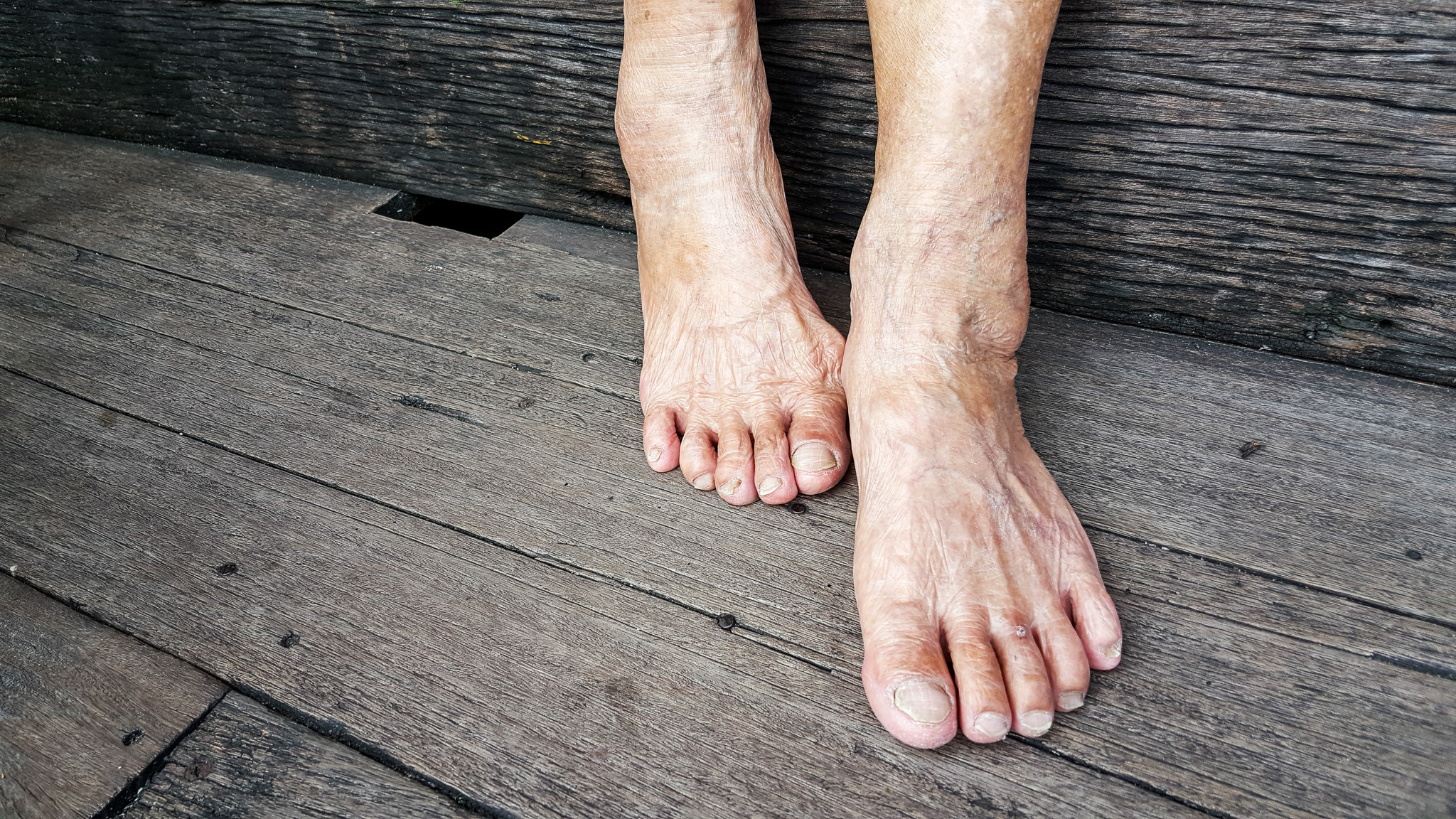 Toenail Fungus Study