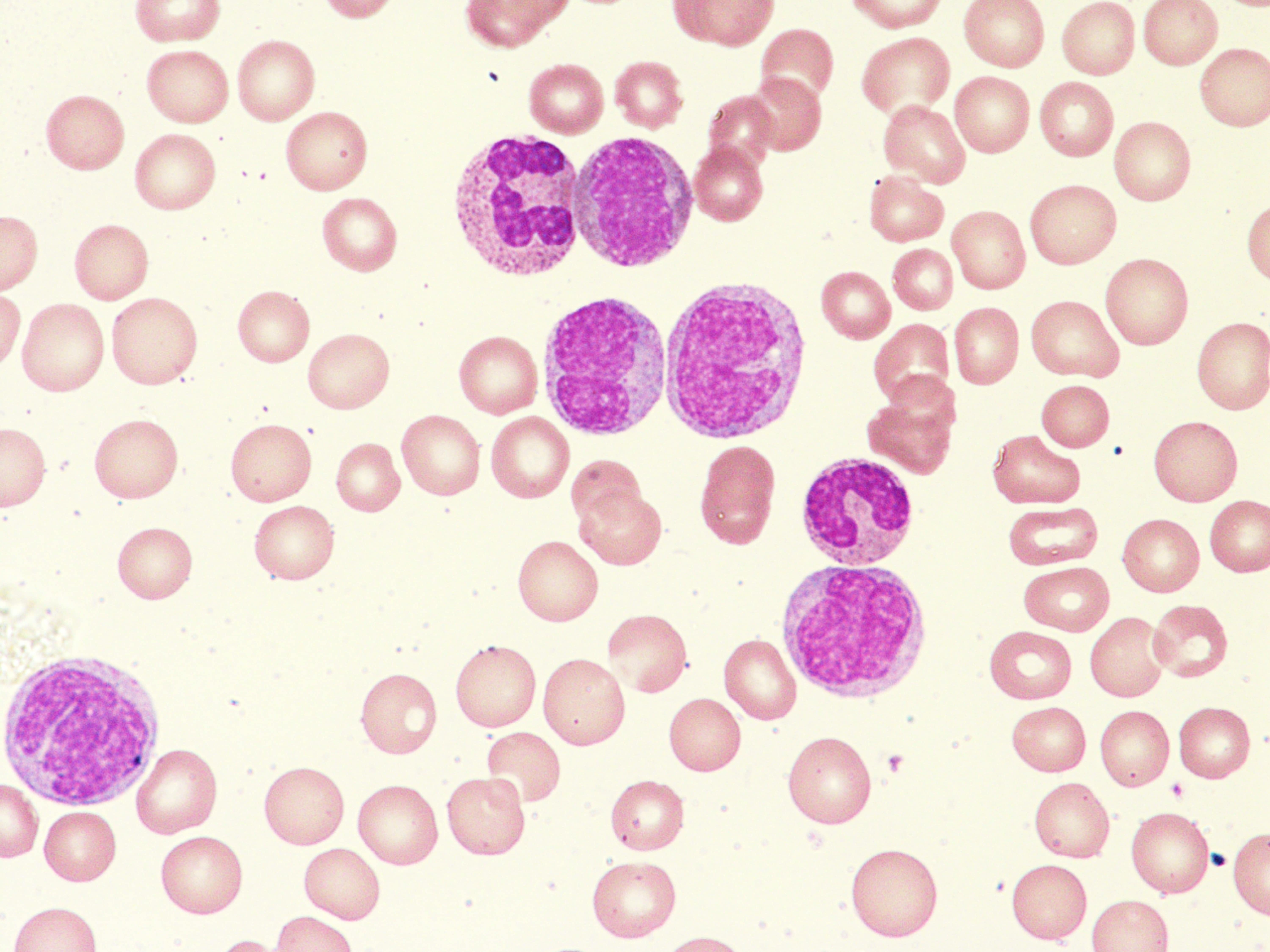 SAHMRI set to be a world leader in chronic myelomonocytic leukaemia